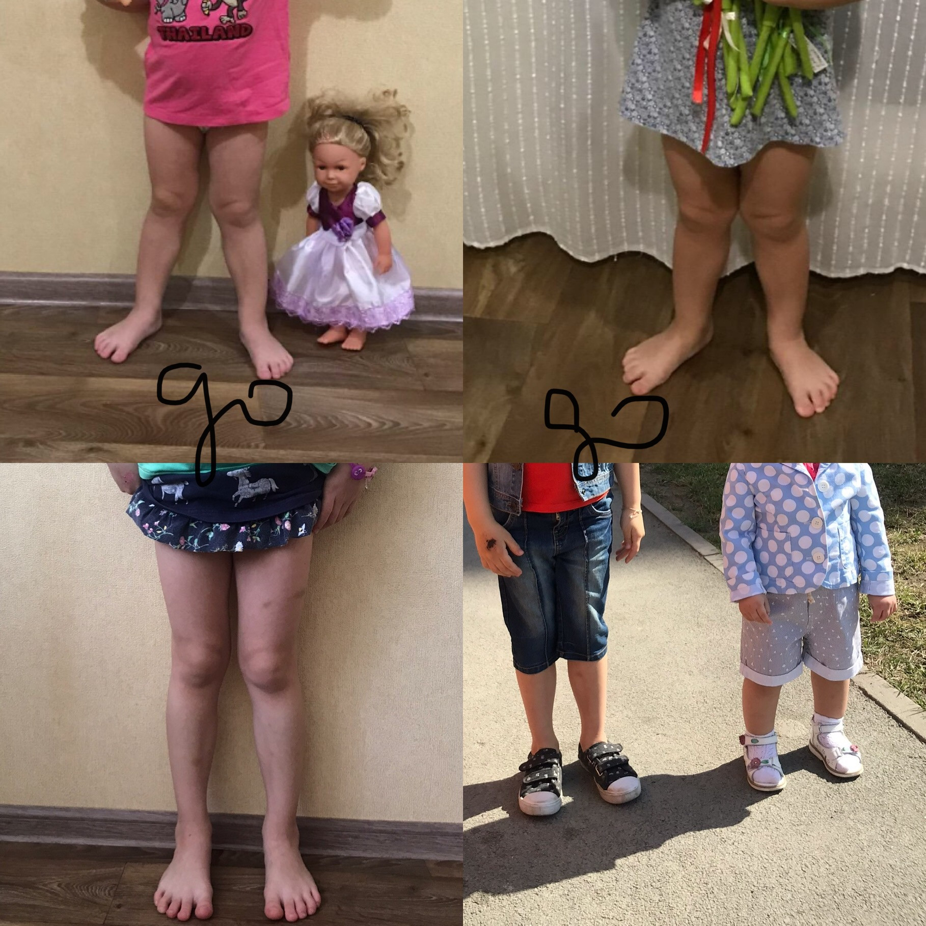 Ножки иксом у ребенка 2 года