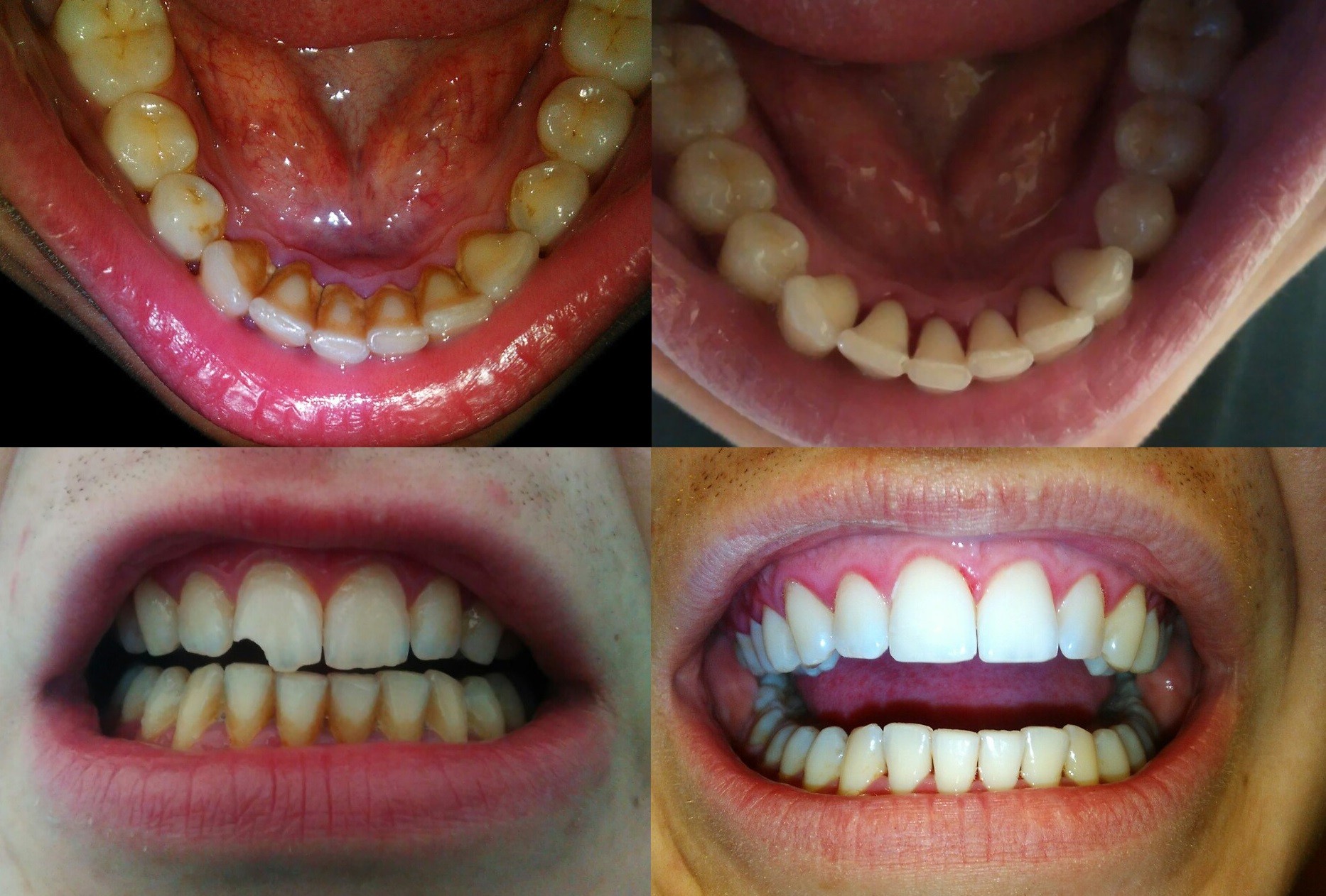 Кариес передних зубов до и после