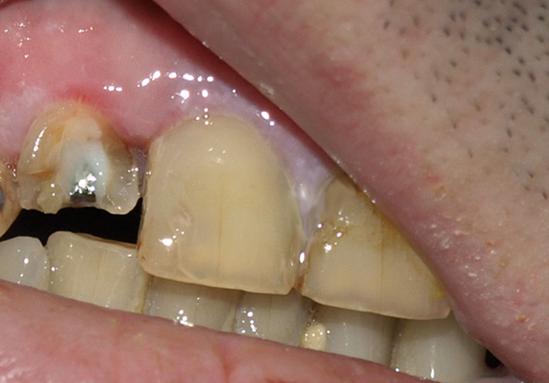 Откололся кусочек зуба — и что теперь делать?