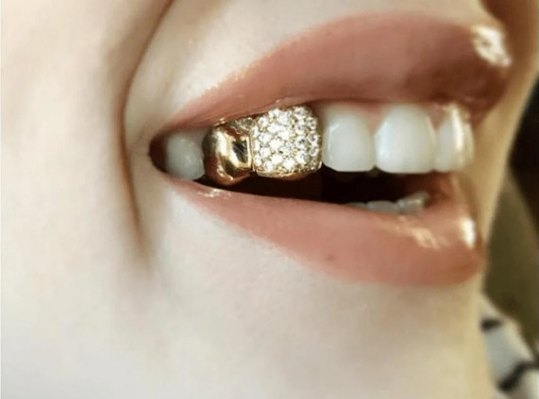 Крошка зуба. Золотые коронки. Золотые коронки с бриллиантами.